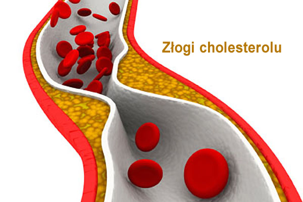 Złogi cholesterolu